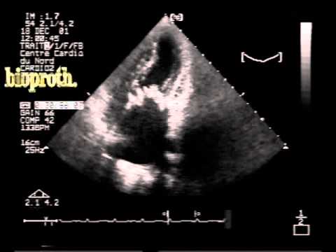 Bioprosthetic Mitral Valve Vegetation With Obstruction And Dehiscence