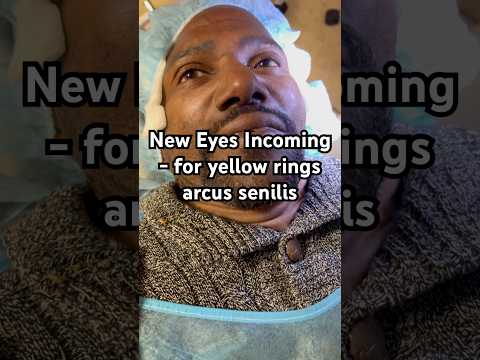 ColorEyes Treats Yellow Arcus Senilis Rings