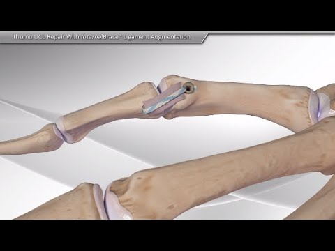 Thumb UCL Repair with InternalBrace™ Ligament Augmentation