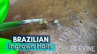 Removing Embedded Hairs From A Brazilian Laser Hai