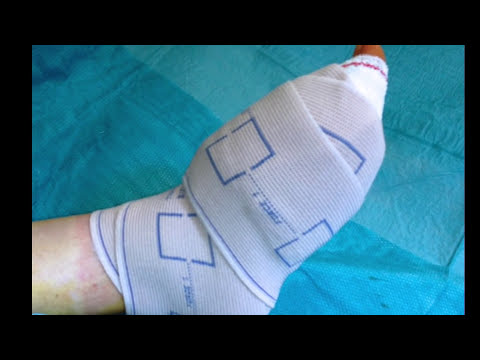 comment traiter orteil cassé