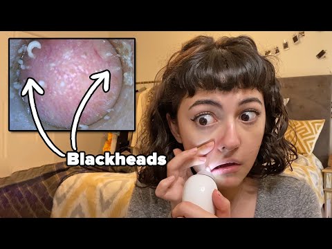 初めて私たちの黒ずみに掃除機をかける (Vacuuming Our Blackheads For The First Time)