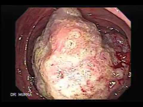 Nádor v hrubom čreve