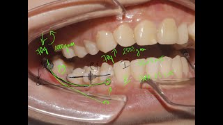 Dựng trục răng 7 hàm dưới, các tình huống lâm sàng và ưu nhược điểm các công cụ