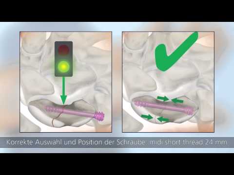 HBS 2 – Minimalinvasive palmare OP-Technik