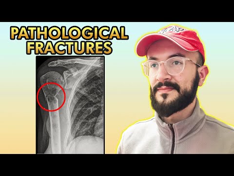 Pathological Fractures: X ray Imaging, Clinical Features and Treatment