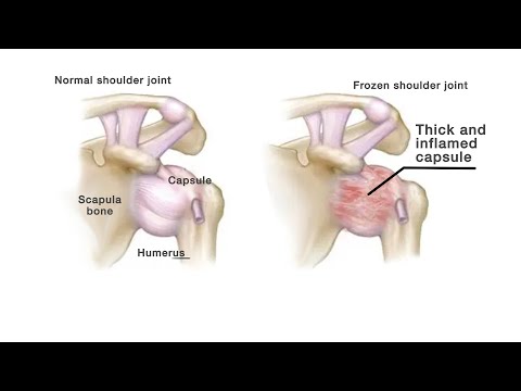 Mayo Clinic Minute: Tips to help a frozen shoulder