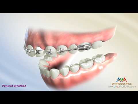 Orthodontic Treatment for Overjet (Overbite) - Wilson Bimetric Distalizing Arch Appliance
