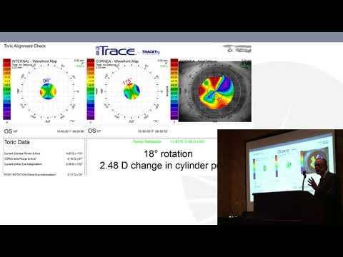 AAO 17 (2) - Dr. Price from iTrace Users Meeting
