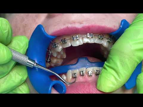 Braces: Putting Braces On Bonding Procedure