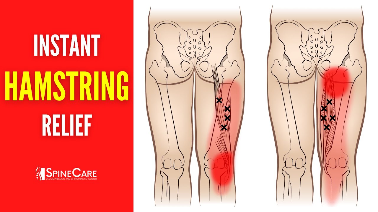 How to Fix Hamstring Pain FOR GOOD