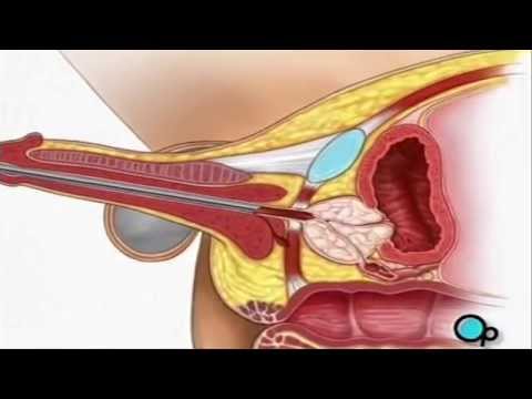 hogyan befolyásolja a prosztatagyulladás az erekciót