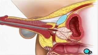TURP Transurethral Resection Prostate (penis) Surgery - PreOp® Patient Education