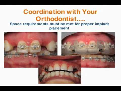 Scan to Plan for Computer Guided Implant Surgery