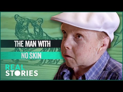 The Boy Whose Skin Fell Off (BAFTA AWARD WINNING DOCUMENTARY) - Real Stories