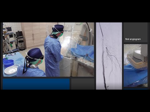Jetstream case – CTO distal popliteal artery – Vascupedia Jetstream case – CTO distal popliteal artery – Vascupedia