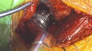 Acetabular Preparation
