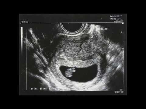 7-WEEK GESTATION ULTRASOUND 7-WEEK EMBRYO 7-WEEK PREGNANCY EMBRYO FETOMETRY