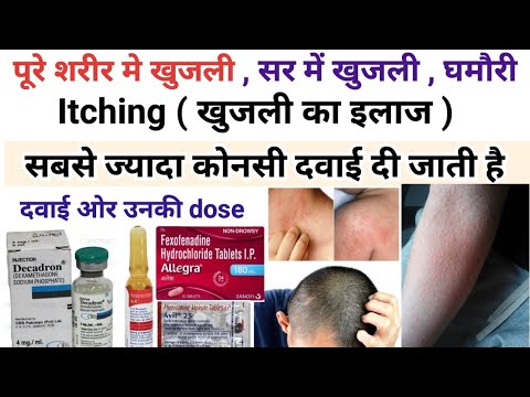 खुजली का इलाज - पूरे शरीर मे खुजली , सर में खुजली , घमौरी 