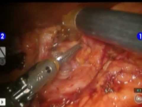 Laparoscopic and Robotic Distal Gastrectomy for Cancer