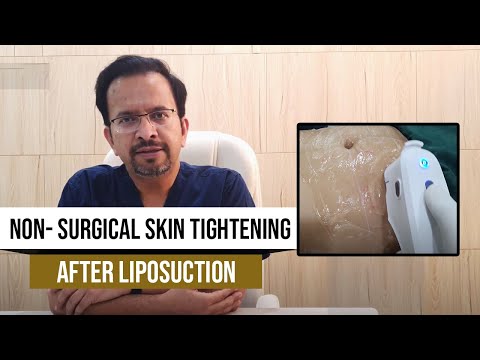 YouTube video about: Does vaser lipo tighten skin?