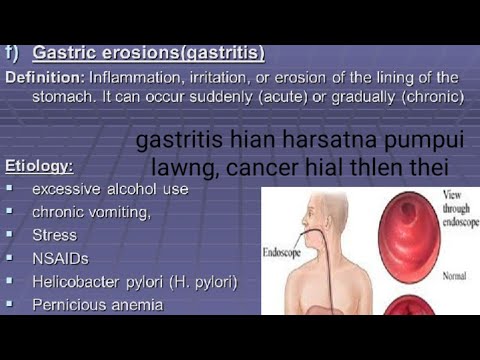 Gastritis( Pumpui sa hut Hut) Lo awm chhan leh in ven dan