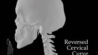 Reversed Cervical Curve - Skull and Neck View