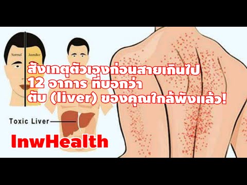 ลดลงจากกลาก ครีมขี้ผึ้งโรคสะเก็ดเงินจริงทั้งหมด