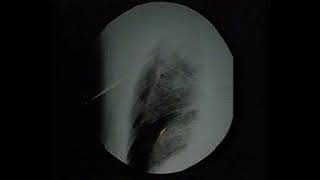 Thoracic drainaga