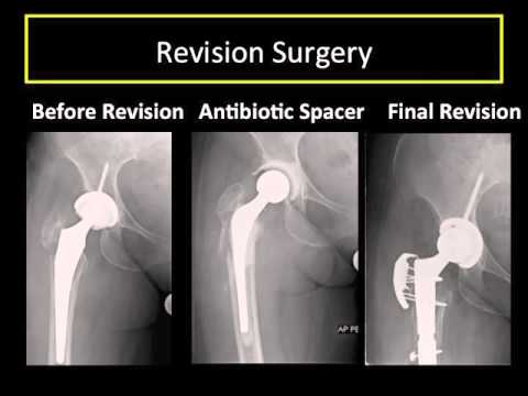 Revision of a Hip Replacement:  Why, How, and What to Expect