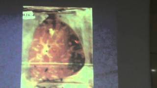 21) Dr. Ahmed Soliman 30-11-2015 [ Belharziaziz liver &lung ]