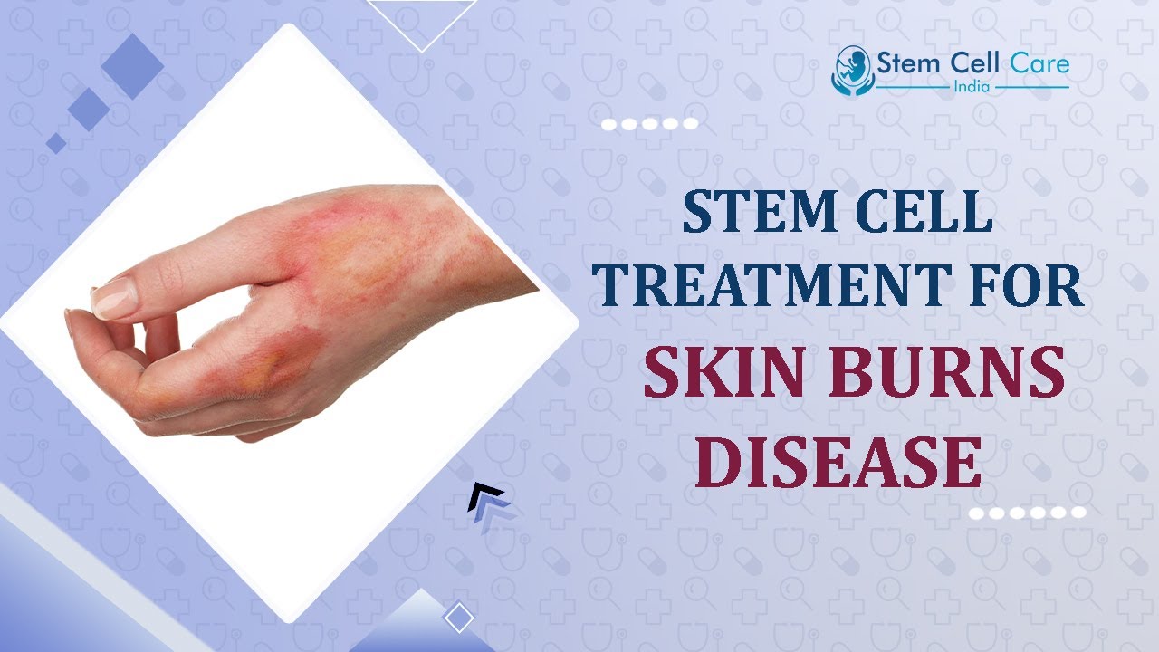 Skin Burns | Best Treatment For Skin Burns | Best Stem Cell Hospital For Skin Burn | Stem Cell 
