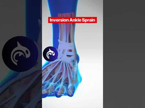 Eversion Ankle Sprain vs Inversion Ankle Sprain