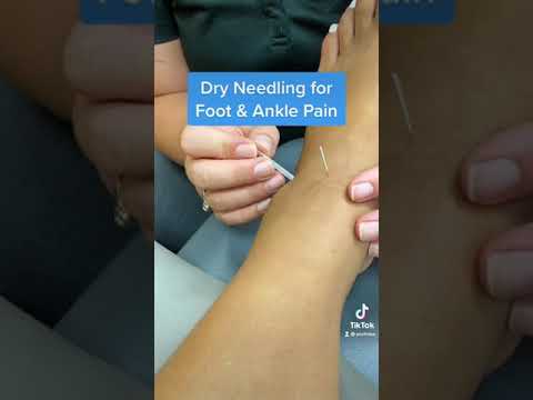 Agulhamento seco para dores nos pés e tornozelos.