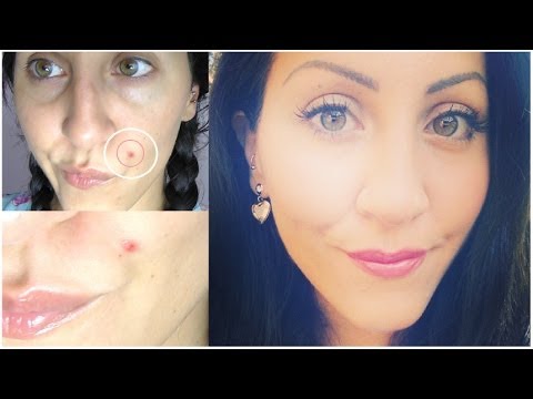 Come togliere un posto di pigmentary su una faccia Le capsule da pigmentary notano su una faccia