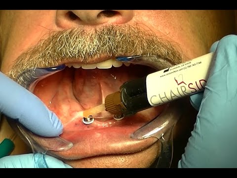 LOCATOR Overdenture Denture Cap Pick-Up — Full Technique