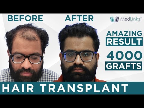 Best hair transplant in delhi