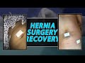 How I'm Going to Recover From Hernia Surgery The FASTEST Way Possible