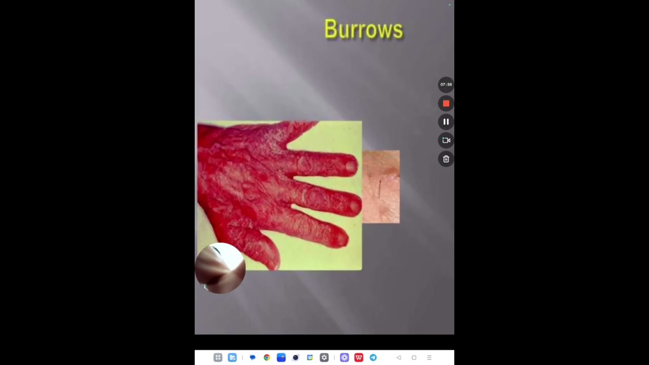 Pyoderma, Scabies and pediculosis   Etiology, Clinical features, Diagnosis and Treatment