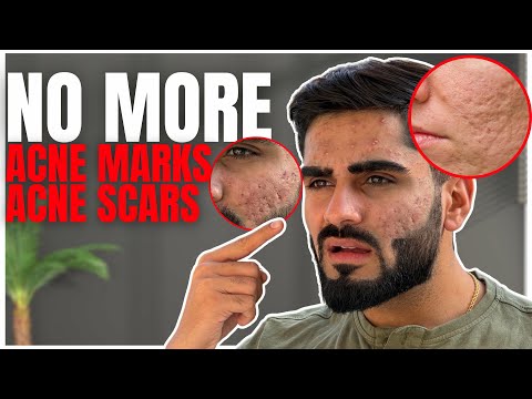 NO MORE ACNE MARKS & ACNE SCARS!😳 Ultimate Teenage Guide to Clear Skin Fast.✨