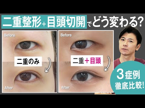 目頭切開について詳しく解説