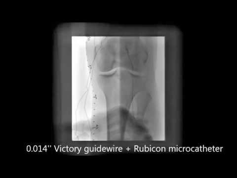 Retrograde revascularization of SFA CTO