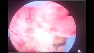 Pólipo endometrial - Evelin Gualotuña Segarra