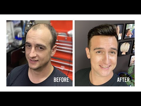 Complete Hair Replacement Application | American...