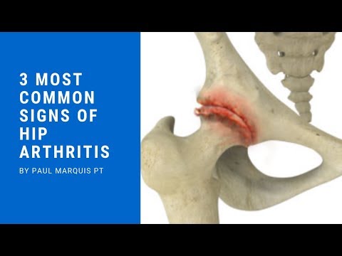 3 Most Common Signs of Hip Arthritis
