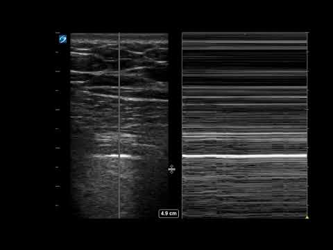 Pneumothorax on Ultrasound: Finding the Lung Point in Real Time