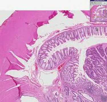 Squamous papilloma ear canal pathology