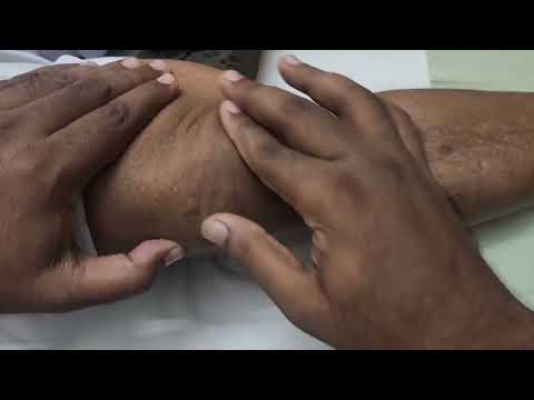 OA Knee Physiotherapy Treatment 