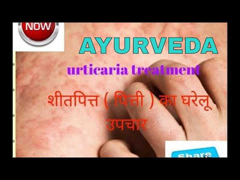 शीतपित्त का उपचार -urticaria treatment/indian ayurveda channel Video