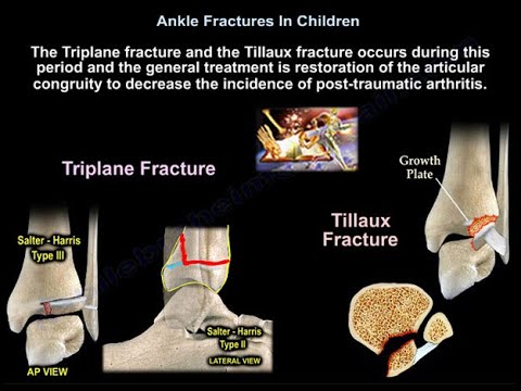 Fracturas de tobillo en niños - Todo lo que se debe saber